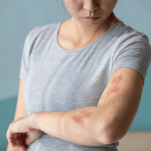 Book A Consultation 3 Herpes consultation 4 panaceayur