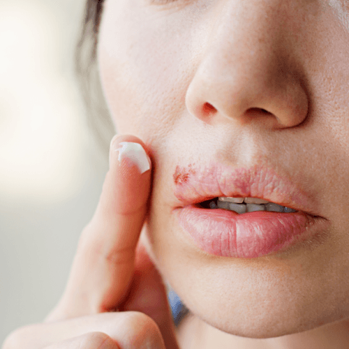 Book A Consultation 6 Herpes consultation panaceayur