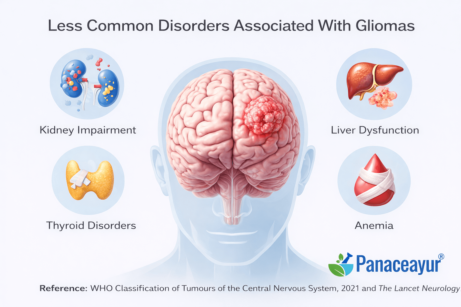 Gliomas - Symptoms, Diagnosis, And Ayurvedic Cure For Brain Tumors 5 Image 28