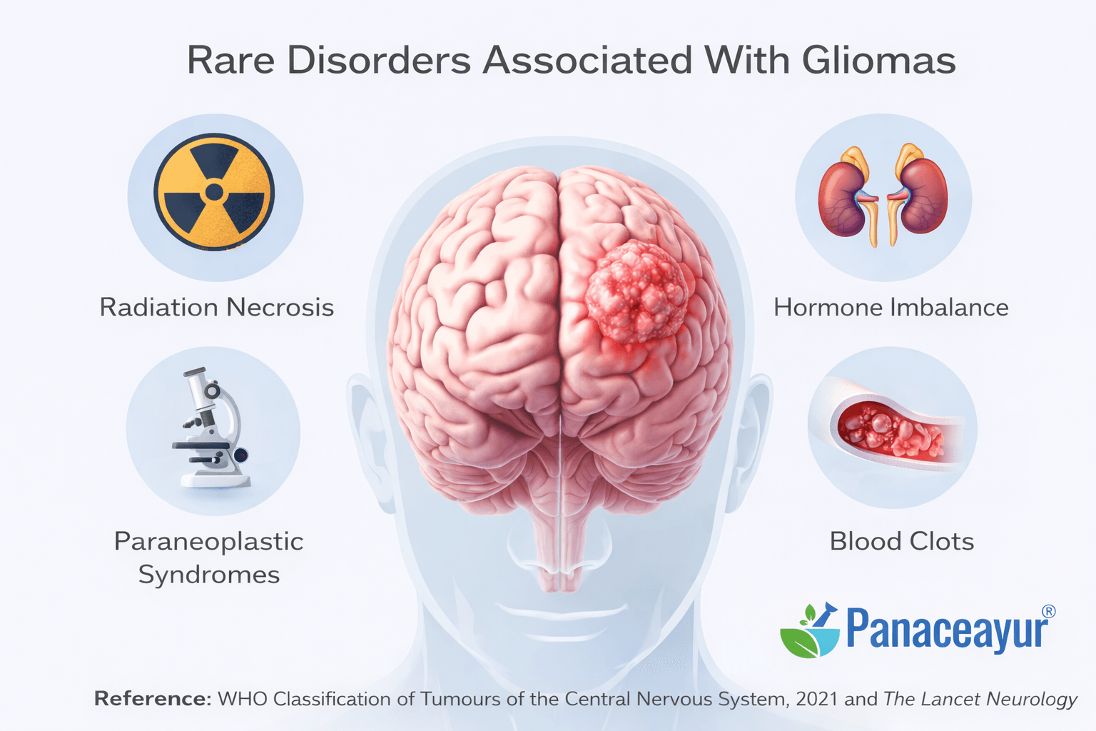 Gliomas - Symptoms, Diagnosis, And Ayurvedic Cure For Brain Tumors 6 Image 29