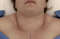 Close-up clinical view of lower-neck swelling in the thyroid region, illustrating inoperable anaplastic thyroid cancer.