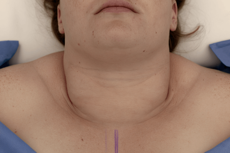 Close-up clinical view of lower-neck swelling in the thyroid region, illustrating inoperable anaplastic thyroid cancer.