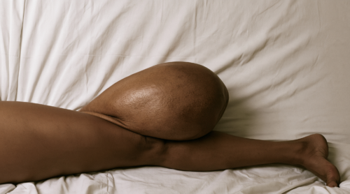 Large localised soft-tissue tumour forming a prominent mass in the upper calf of an adult patient.
