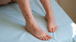 patient showing bruising and red petechiae on legs, possible leukemia symptom linked with low platelets
