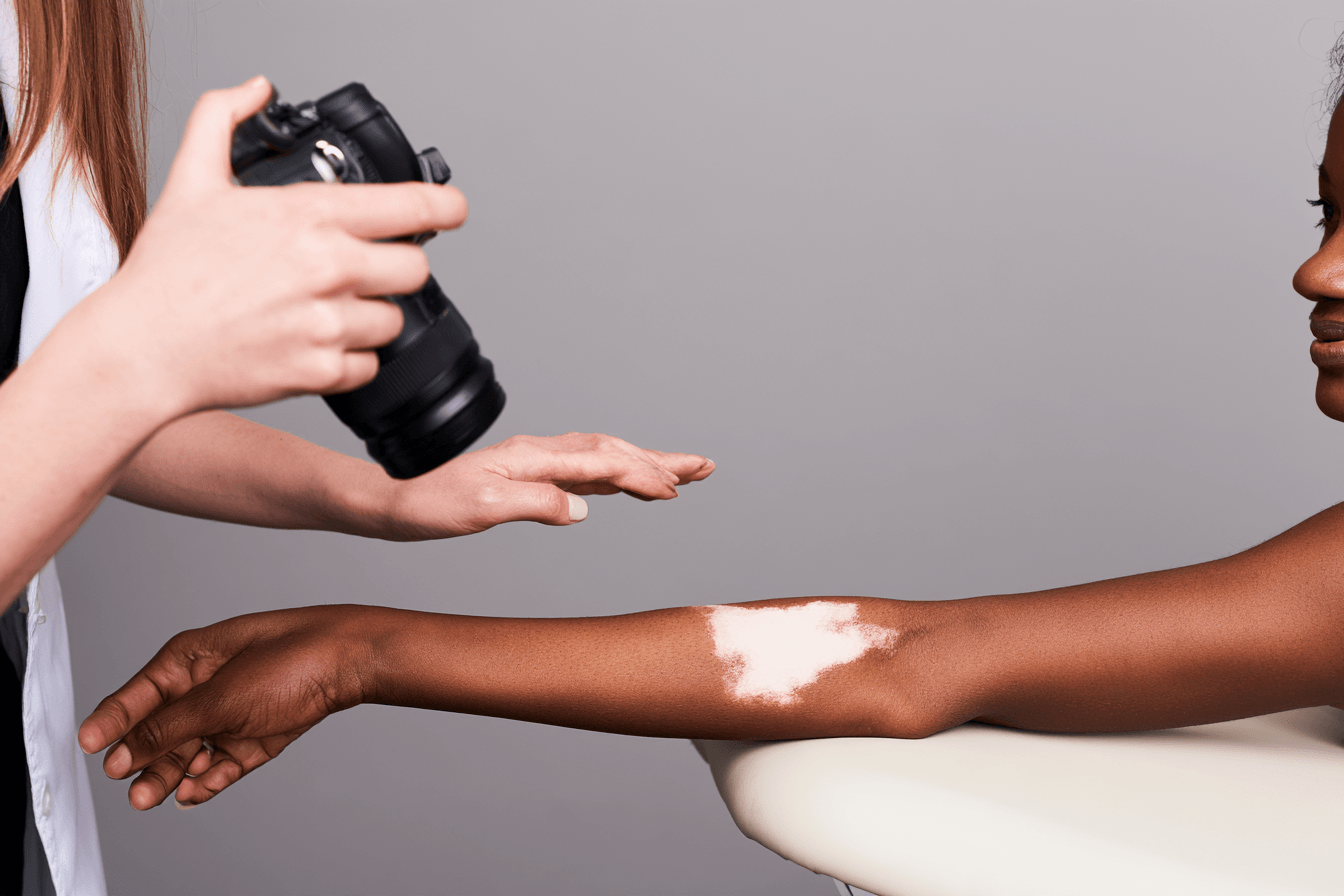 Can Vitiligo Be Cured Permanently? Treatment Results And Ayurveda 5 Clinician photographing a vitiligo patch on a woman’s forearm during a review.