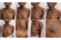 Clinical collage illustrating cachexia, supraclavicular swelling and skin nodules associated with metastatic esophageal cancer.