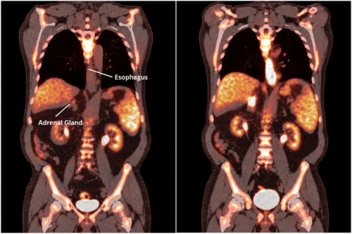 Metastatic esophageal cancer treatment illustration with labeled, side-by-side PET-CT-style torso views.