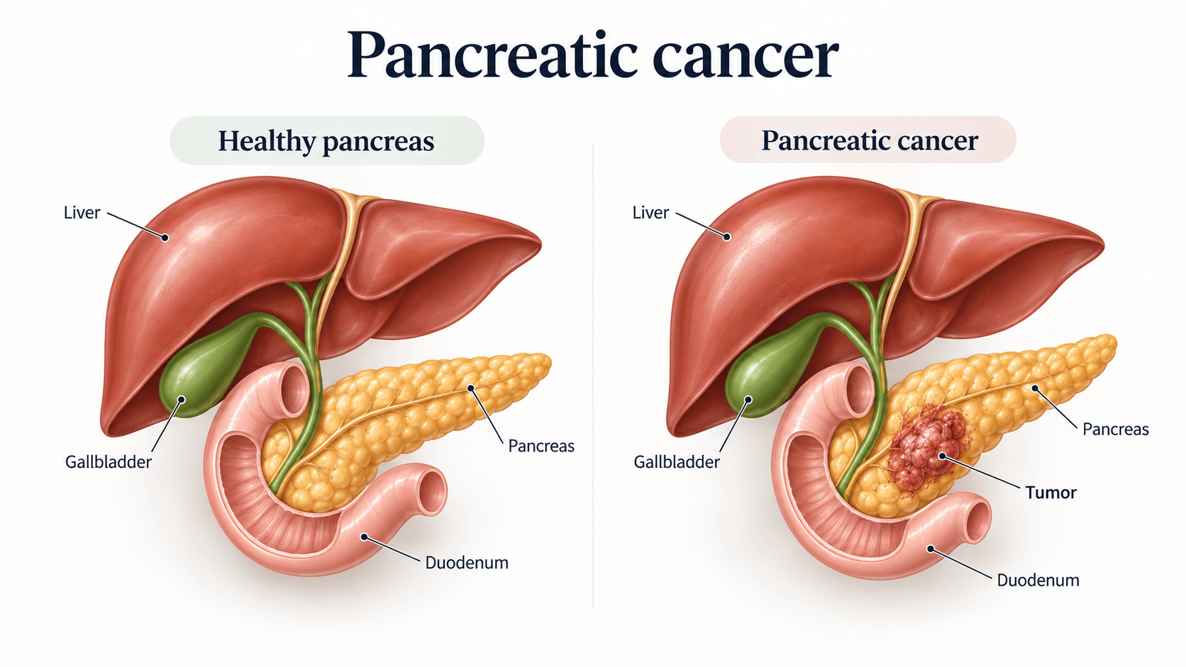 Pancreatic Cancer: Ayurvedic Approach, Causes, Treatment 1 High-quality medical illustration showing the difference between a healthy pancreas and pancreatic cancer. The image highlights the pancreas, liver, gallbladder, duodenum and tumor area to help patients understand disease anatomy and treatment planning.