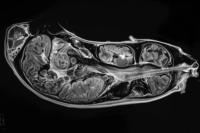 CT scan showing subtle pancreatic cancer recurrence after treatment