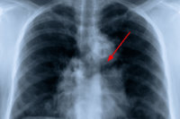Chest X-ray with a red arrow highlighting a left hilar mass-like opacity in suspected recurrent small cell lung cancer.
