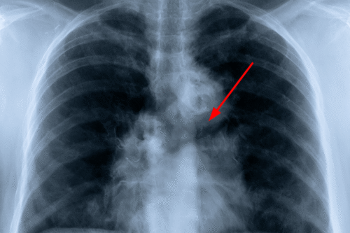 Chest X-ray with a red arrow highlighting a left hilar mass-like opacity in suspected recurrent small cell lung cancer.