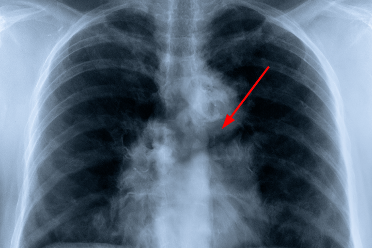 Chest X-ray with a red arrow highlighting a left hilar mass-like opacity in suspected recurrent small cell lung cancer.