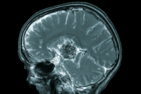 Contrast enhanced brain MRI showing a ring enhancing metastatic brain lesion in a patient with small cell lung cancer.