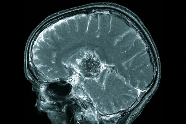 Home 4 Contrast enhanced brain mri showing a ring enhancing metastatic brain lesion in a patient with small cell lung cancer.