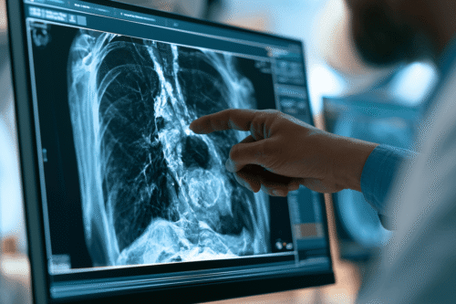Oncologist reviewing a chest CT showing a central lung tumour while explaining small cell lung cancer survival by stage to a patient.