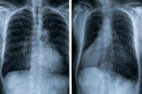 Small cell lung cancer treatment chest X-ray with frontal and lateral views showing a suspected central lung lesion