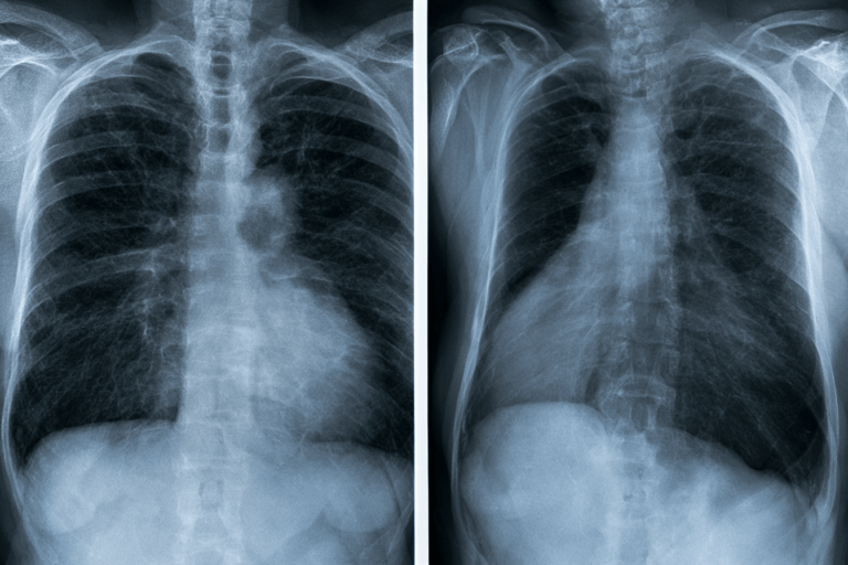 Small cell lung cancer treatment chest X-ray with frontal and lateral views showing a suspected central lung lesion