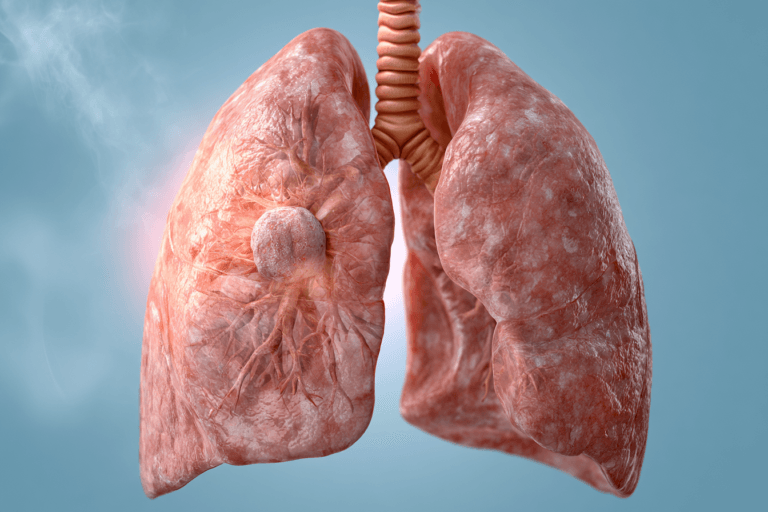 Clear medical illustration of human lungs showing a cancerous tumor in one lung for small cell and non small cell lung cancer education.