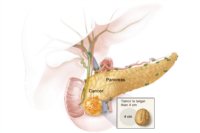 Stage 1 pancreatic cancer showing small tumor confined within the pancreas with anatomical location and early stage tumor visualization