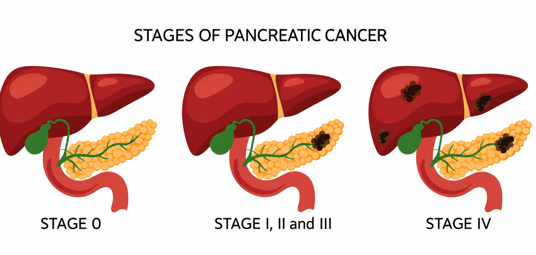 Pancreatic Cancer: Ayurvedic Approach, Causes, Treatment 8 Stages of pancreatic cancer showing pancreas, liver involvement, early stage disease, locally advanced cancer and stage 4 metastatic pancreatic cancer