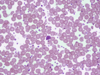 Microscope image of thalassemia blood smear showing microcytic hypochromic red blood cells with central pallor and irregular shapes.
