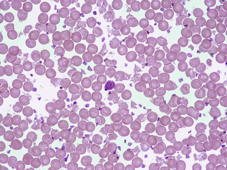 Home 1 Microscope image of thalassemia blood smear showing microcytic hypochromic red blood cells with central pallor and irregular shapes.