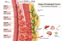 Where esophageal cancer spreads to the liver, lungs, bones, brain and lymph nodes