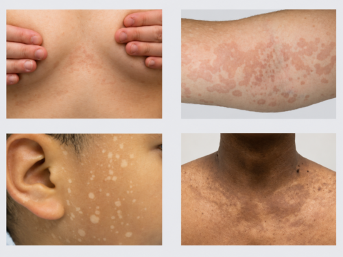 White patches on skin showing different hypopigmented patterns that may resemble vitiligo, tinea versicolor, or other pigment disorders.